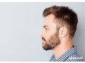 without-shaving-get-hair-restoration-with-biofue-small-0