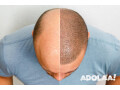 elite-hair-transplant-services-in-dubai-small-0