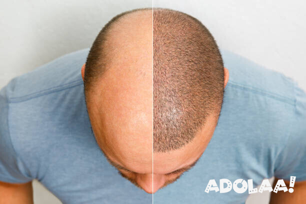 elite-hair-transplant-services-in-dubai-big-0