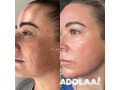 best-dermal-filler-treatment-in-page-small-0