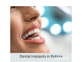 hire-dental-implants-in-robina-small-0