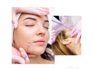 Thread Face Lift Technique Burlington - No More Medical Spa Wrinkles