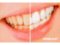 things-to-consider-before-undergoing-teeth-whitening-in-south-east-london-small-0