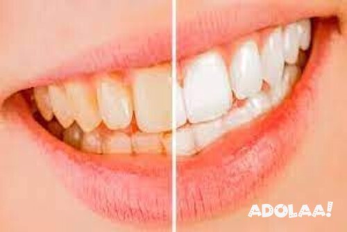 things-to-consider-before-undergoing-teeth-whitening-in-south-east-london-big-0