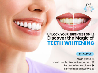 Revitalize Your Smile with Teeth Whitening at Kamal Smiles Dental Care!