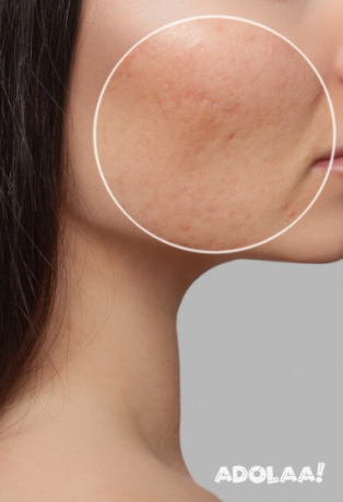 laser-hair-removal-in-hyderabad-big-1