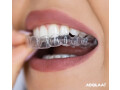 invisible-orthodontics-in-shyamal-small-0