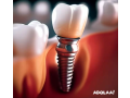 best-dental-implants-in-ahmedabad-dr-robins-dental-clinic-small-0