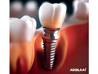 Best Dental Implants in Ahmedabad - Dr. Robins Dental Clinic