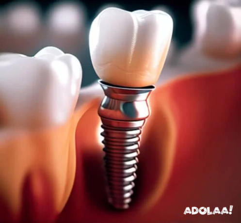 best-dental-implants-in-ahmedabad-dr-robins-dental-clinic-big-0