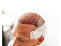 male-pattern-hair-loss-in-gurgaon-small-0