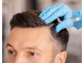 hair-restoration-treatment-in-gurgaon-small-0