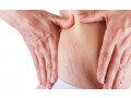 stretch-marks-treatment-in-delhi-small-0