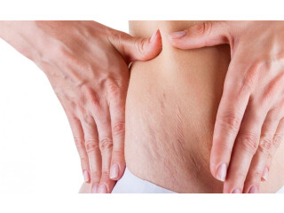 Stretch Marks Treatment in Delhi