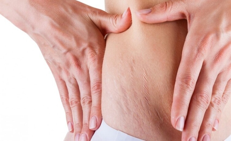 stretch-marks-treatment-in-delhi-big-0