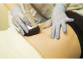 stomach-laser-hair-removal-in-delhi-small-0