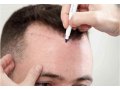 hair-transplant-cost-in-jaipur-small-0