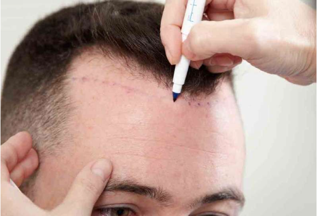 hair-transplant-cost-in-jaipur-big-0