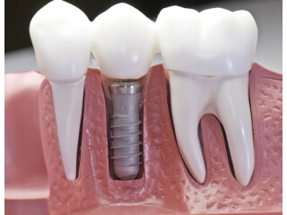 Dental Implant In Vidhyadhar Nagar