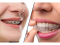 orthodontist-in-mansarovar-jaipur-small-0