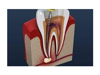 Root Canal Treatment in kalwar Road Jaipur