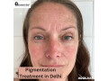 pigmentation-treatment-in-delhi-dr-syed-small-0