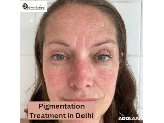 Pigmentation Treatment in Delhi | Dr Syed