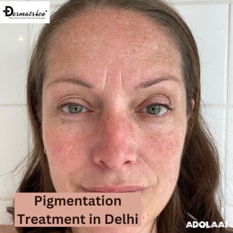 pigmentation-treatment-in-delhi-dr-syed-big-0