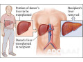 liver-transplant-in-india-small-0