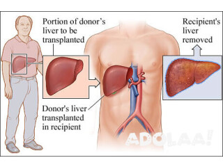 Liver transplant in India