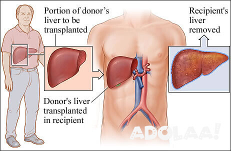 liver-transplant-in-india-big-0