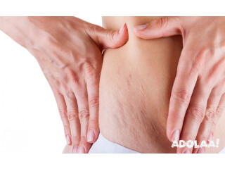 Get Stretch Mark Free Glowing Skin with Stretch Mark Treatment