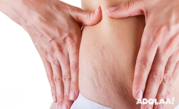 get-stretch-mark-free-glowing-skin-with-stretch-mark-treatment-big-0