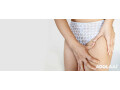 love-your-skin-with-effective-stretch-mark-removal-treatment-small-0