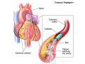 coronary-angiogram-treatment-cost-in-india-small-0