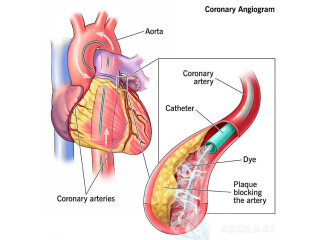 Coronary angiogram treatment cost in India