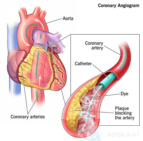 coronary-angiogram-treatment-cost-in-india-big-0