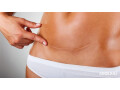 scar-removal-treatment-in-delhi-at-an-affordable-cost-small-0