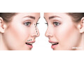 rhinoplasty-surgery-in-delhi-dr-sachin-rajpal-small-0