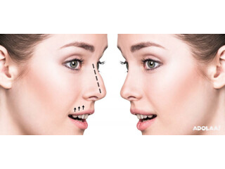 RHINOPLASTY SURGERY IN DELHI | DR. SACHIN RAJPAL