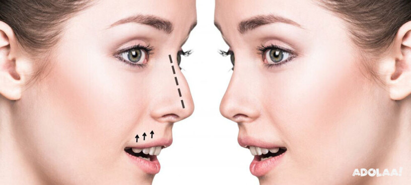 rhinoplasty-surgery-in-delhi-dr-sachin-rajpal-big-0