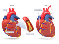 coronary-artery-bypass-grafting-surgery-in-india-small-0