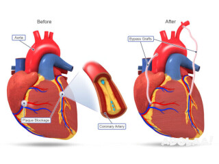 Coronary Artery Bypass Grafting Surgery in India