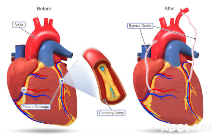 coronary-artery-bypass-grafting-surgery-in-india-big-0