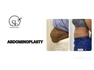 Best Abdominoplasty Surgery in Bangalore - Dr. Sandhya Balasubramanyan