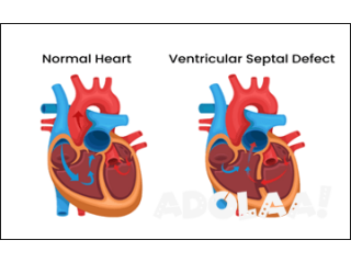 ASD/VSD closure surgery in India