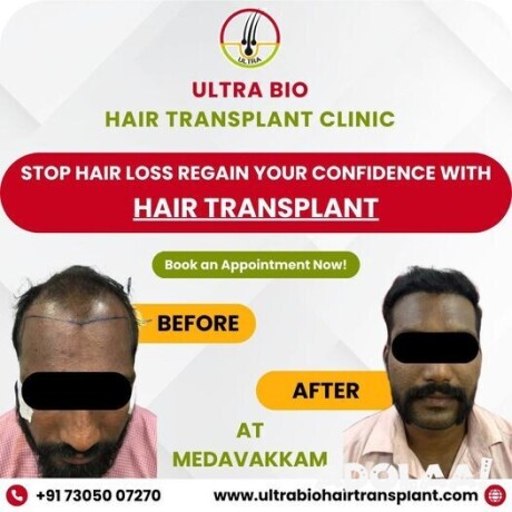 hair-treatment-in-chennai-big-2