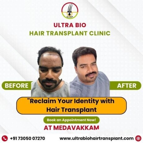 hair-treatment-in-chennai-big-1