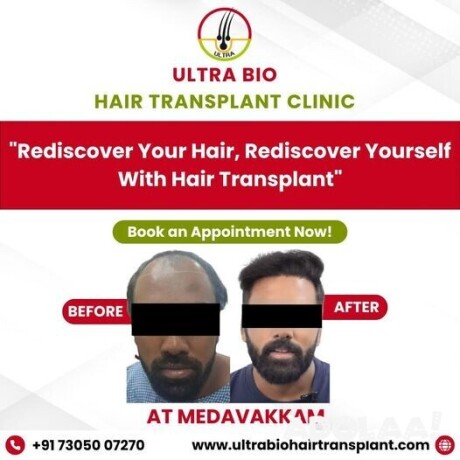 hair-treatment-in-chennai-big-0