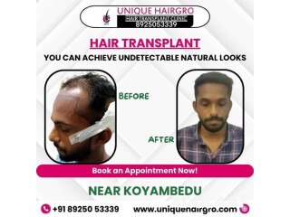 Best hair transplant clinic in tamilnadu